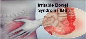 IRRITABLE BOWEL SYNDROME