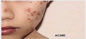 ACNE-/-PIMPLES-(FACIAL)