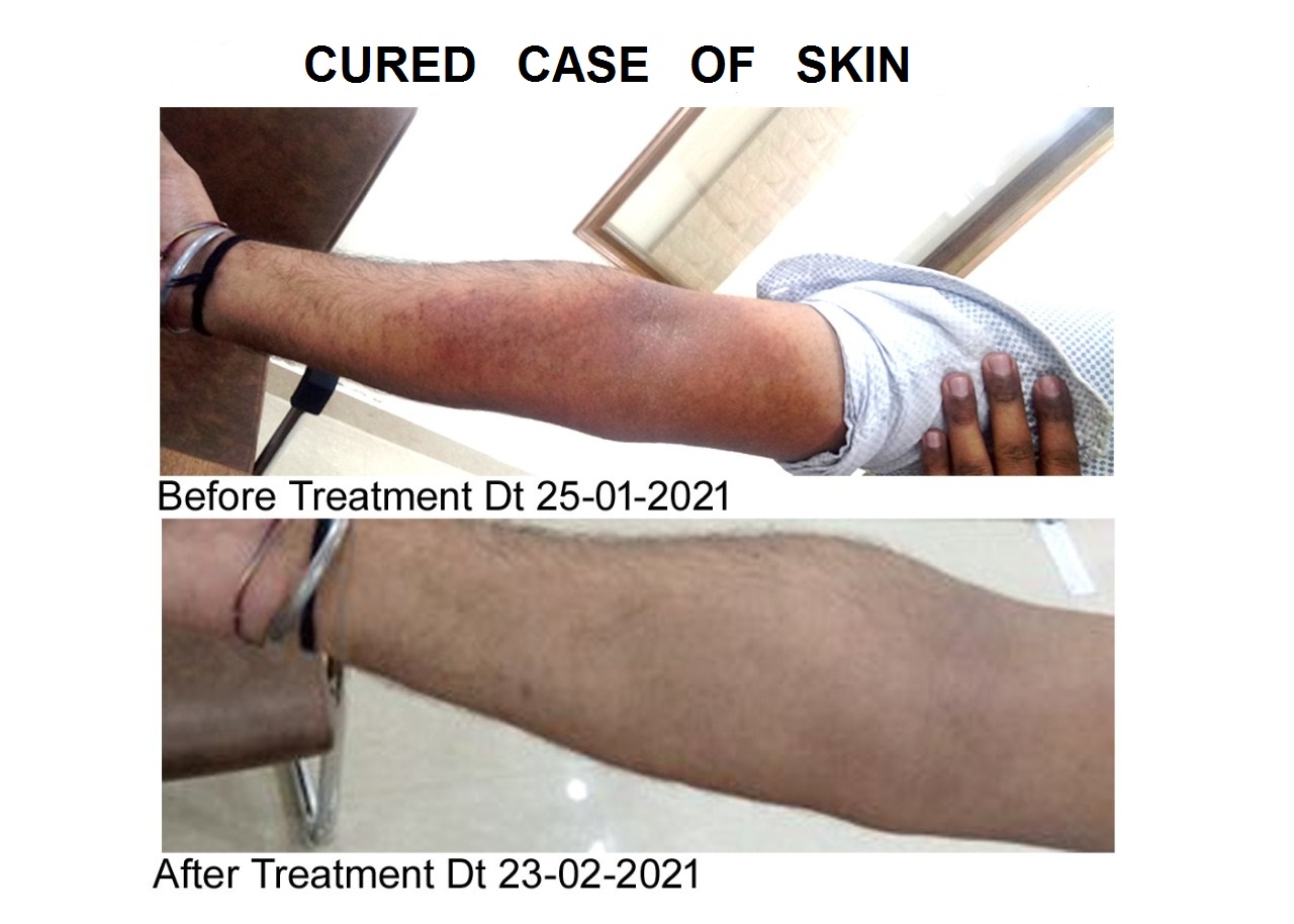 Cured case of SKIN 